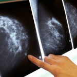 Народные методы лечения рака молочной железы